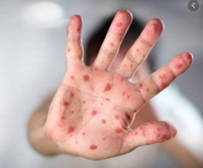 BÀI TUYÊN TRUYỀN PHÒNG, CHỐNG BÊNH TAY CHÂN MIỆNG